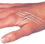 Wound Closure Strips